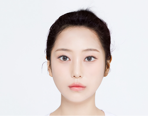 Non-incision hair transplant after