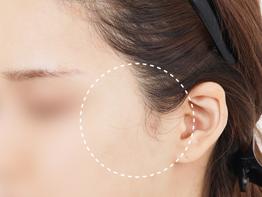 Sideburn scars after contouring / lifting