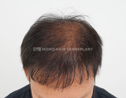 남성 혼용 모발이식 after