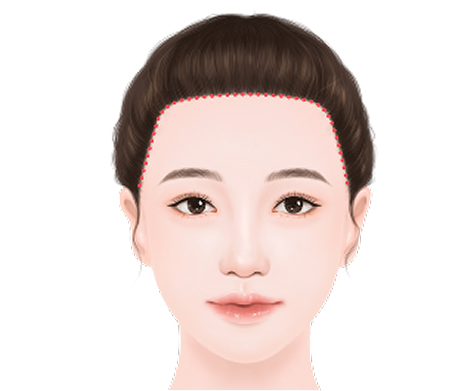 각진 이마