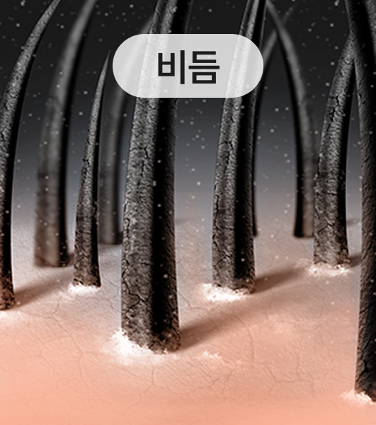 비듬